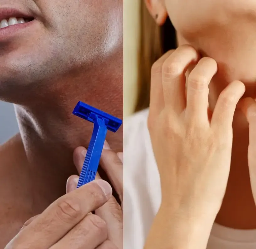 Depilação Laser Contagem, Foliculite, irritação