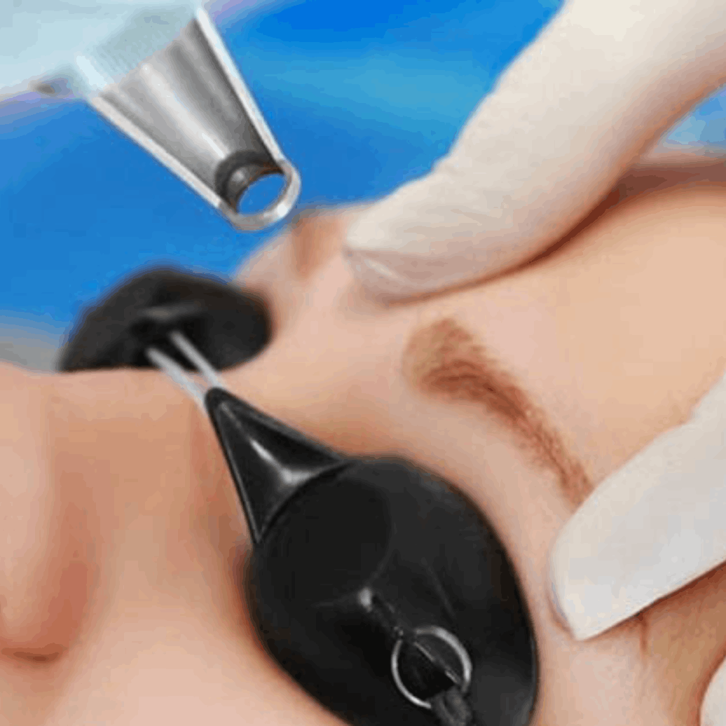 Remoção e Correção de Micropigmentação de Sobrancelhas Contagem